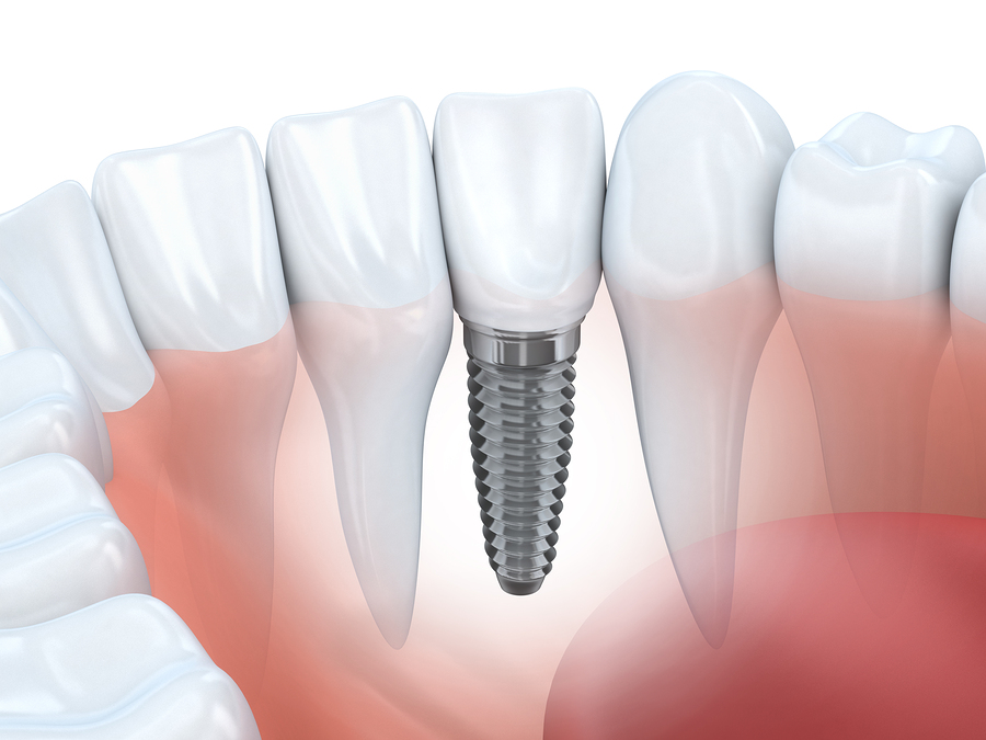 Dental Implants | Dentist In  Minneapolis, MN | Nicollet Mall Dental Arts